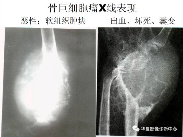【PPT】骨巨细胞瘤的影像诊断及鉴别诊断
