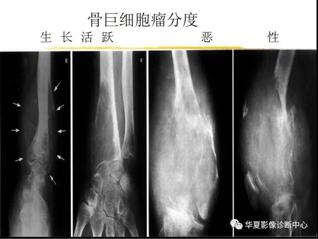 【PPT】骨巨细胞瘤的影像诊断及鉴别诊断
