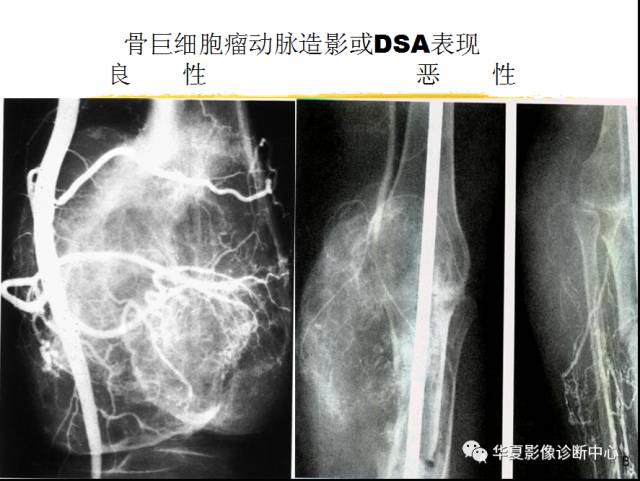 【PPT】骨巨细胞瘤的影像诊断及鉴别诊断