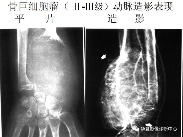 【PPT】骨巨细胞瘤的影像诊断及鉴别诊断
