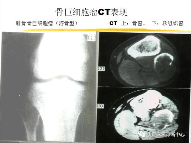 【PPT】骨巨细胞瘤的影像诊断及鉴别诊断
