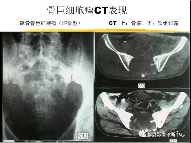 【PPT】骨巨细胞瘤的影像诊断及鉴别诊断