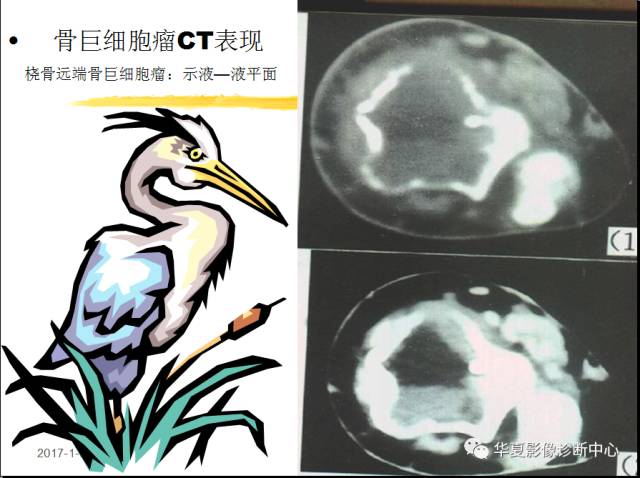 【PPT】骨巨细胞瘤的影像诊断及鉴别诊断