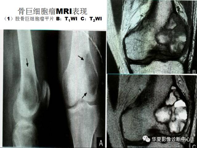 【PPT】骨巨细胞瘤的影像诊断及鉴别诊断