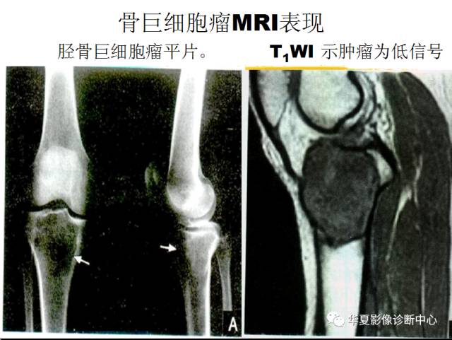 【PPT】骨巨细胞瘤的影像诊断及鉴别诊断
