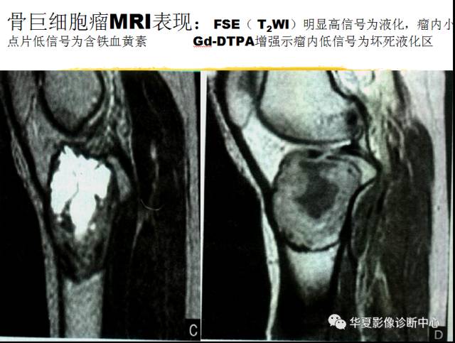 【PPT】骨巨细胞瘤的影像诊断及鉴别诊断