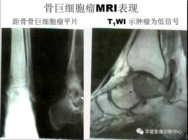 【PPT】骨巨细胞瘤的影像诊断及鉴别诊断