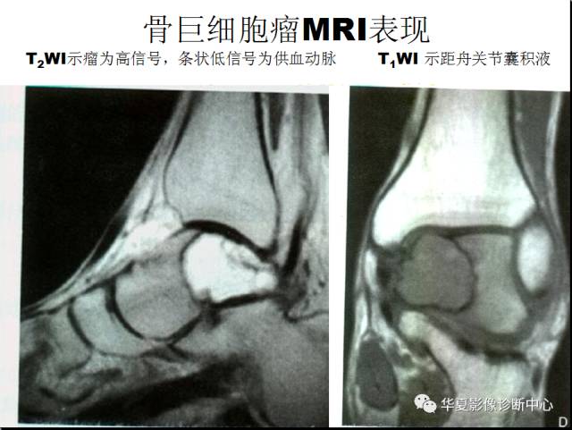 【PPT】骨巨细胞瘤的影像诊断及鉴别诊断