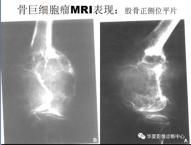 【PPT】骨巨细胞瘤的影像诊断及鉴别诊断
