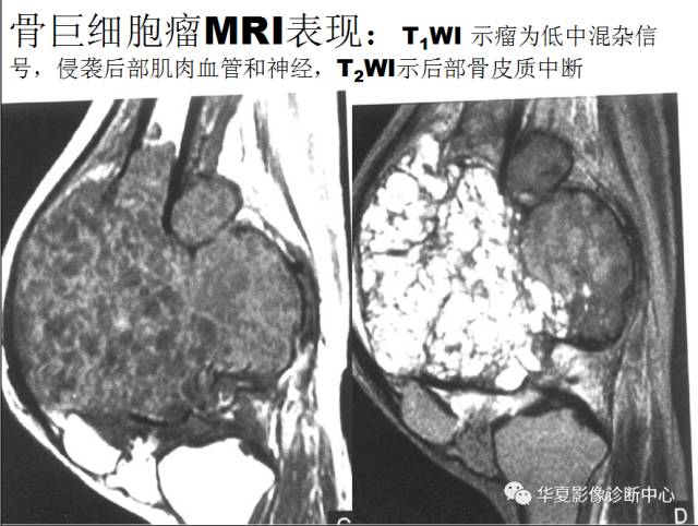 【PPT】骨巨细胞瘤的影像诊断及鉴别诊断