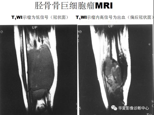 【PPT】骨巨细胞瘤的影像诊断及鉴别诊断