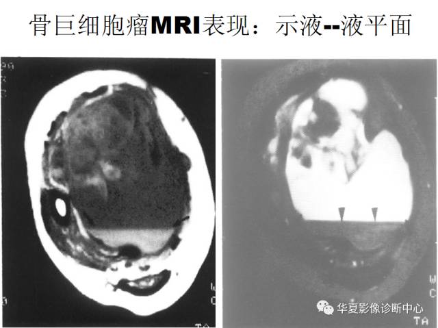 【PPT】骨巨细胞瘤的影像诊断及鉴别诊断
