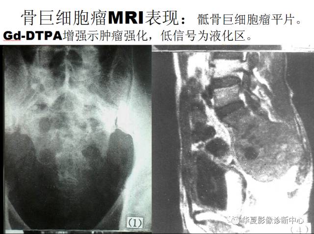 【PPT】骨巨细胞瘤的影像诊断及鉴别诊断