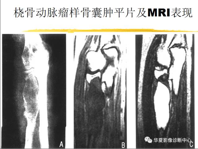 【PPT】骨巨细胞瘤的影像诊断及鉴别诊断