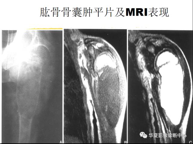 【PPT】骨巨细胞瘤的影像诊断及鉴别诊断