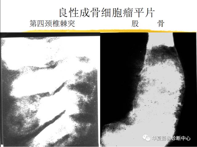 【PPT】骨巨细胞瘤的影像诊断及鉴别诊断