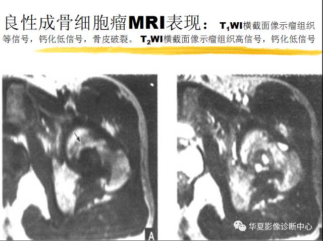 【PPT】骨巨细胞瘤的影像诊断及鉴别诊断