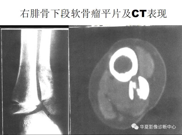 【PPT】骨巨细胞瘤的影像诊断及鉴别诊断