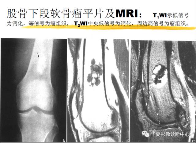 【PPT】骨巨细胞瘤的影像诊断及鉴别诊断
