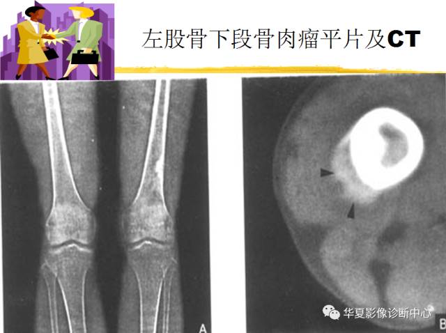 【PPT】骨巨细胞瘤的影像诊断及鉴别诊断