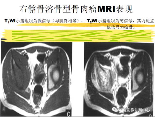 【PPT】骨巨细胞瘤的影像诊断及鉴别诊断