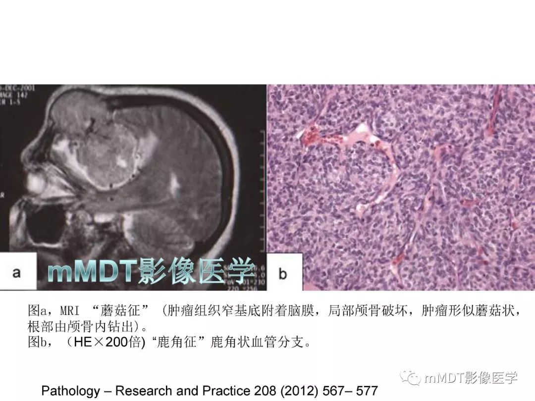 【PPT】脑膜肿瘤影像诊断——间质、非脑膜上皮性源性脑膜肿瘤