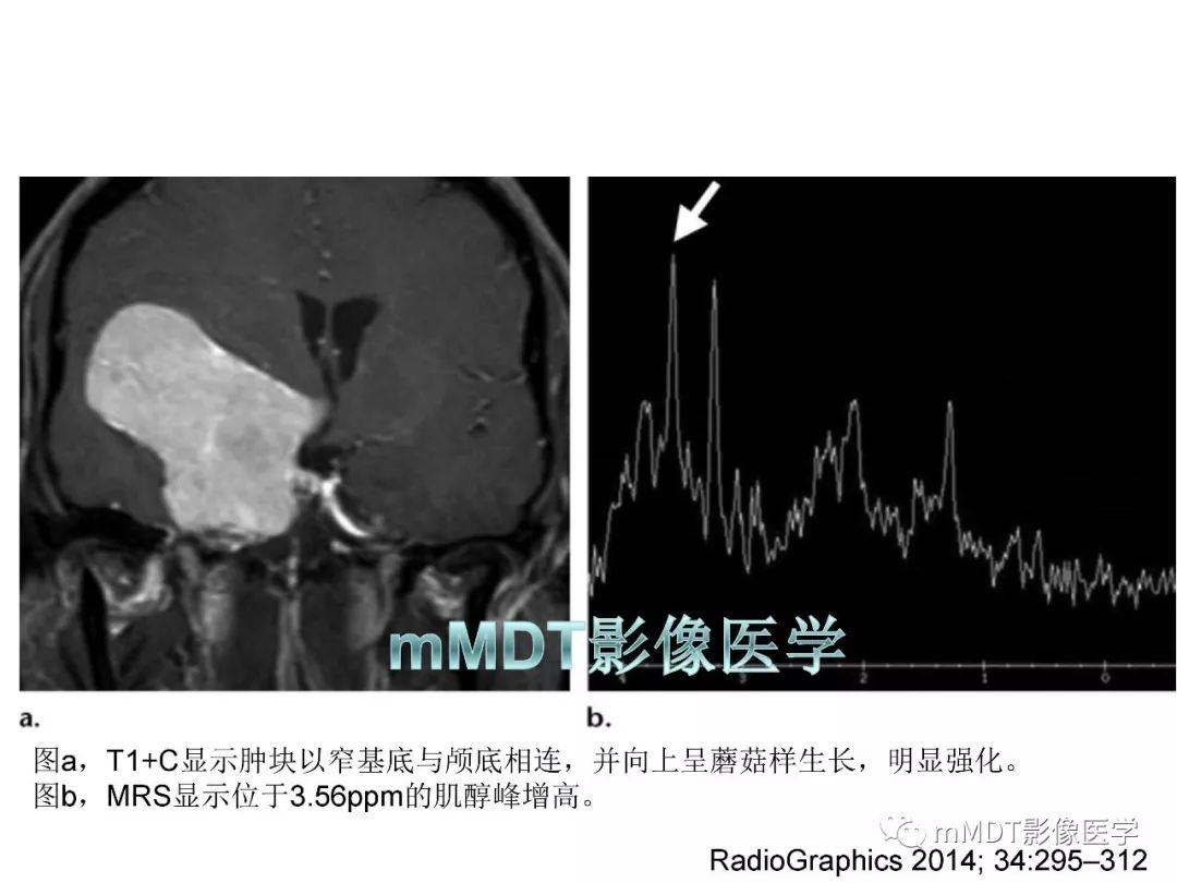 【PPT】脑膜肿瘤影像诊断——间质、非脑膜上皮性源性脑膜肿瘤