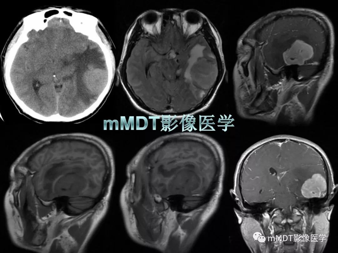 【PPT】脑膜肿瘤影像诊断——间质、非脑膜上皮性源性脑膜肿瘤