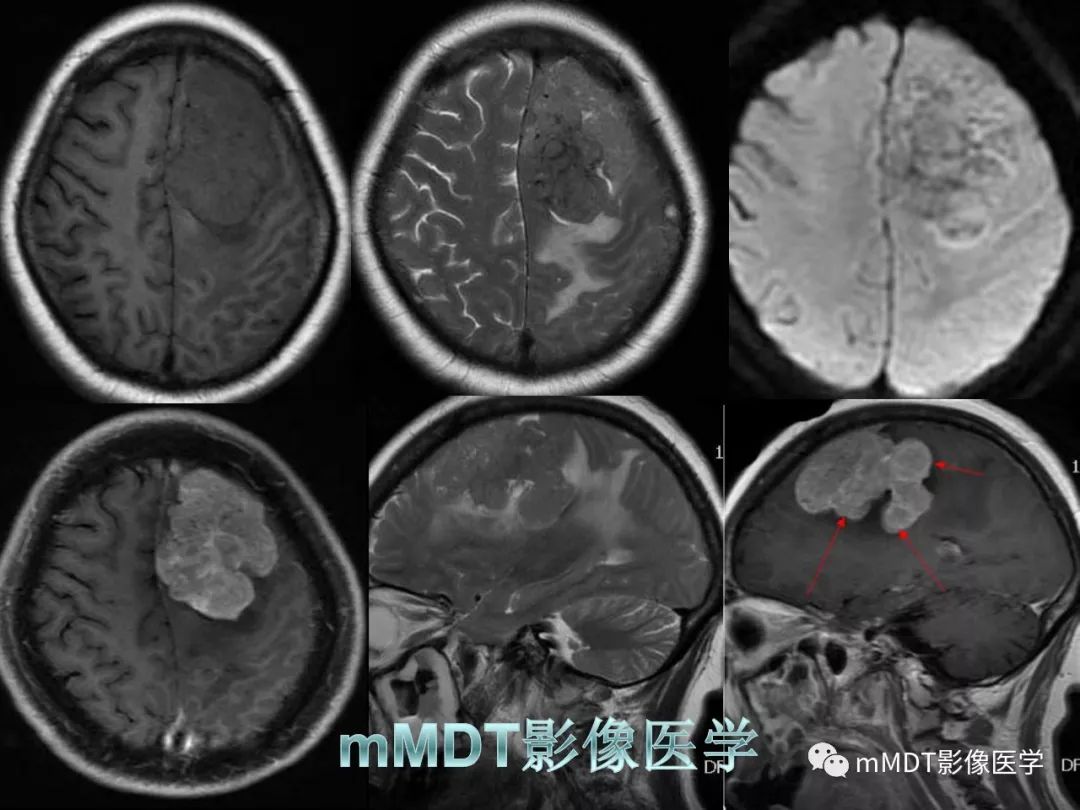 【PPT】脑膜肿瘤影像诊断——间质、非脑膜上皮性源性脑膜肿瘤