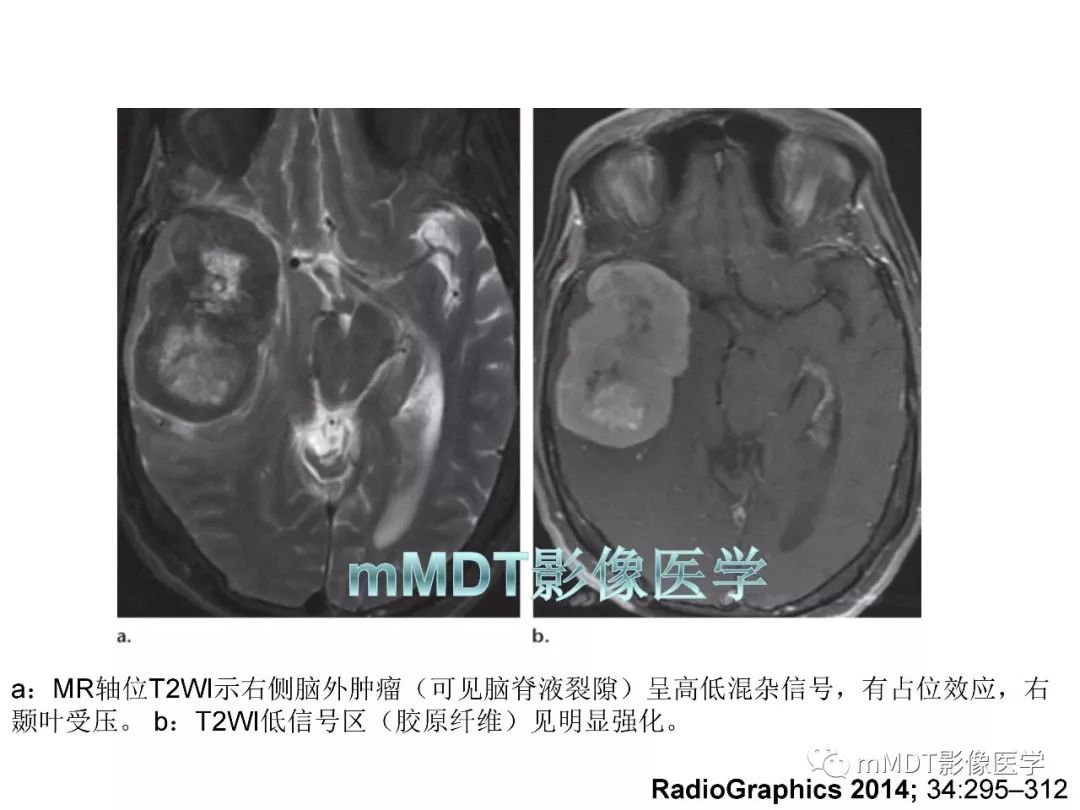 【PPT】脑膜肿瘤影像诊断——间质、非脑膜上皮性源性脑膜肿瘤
