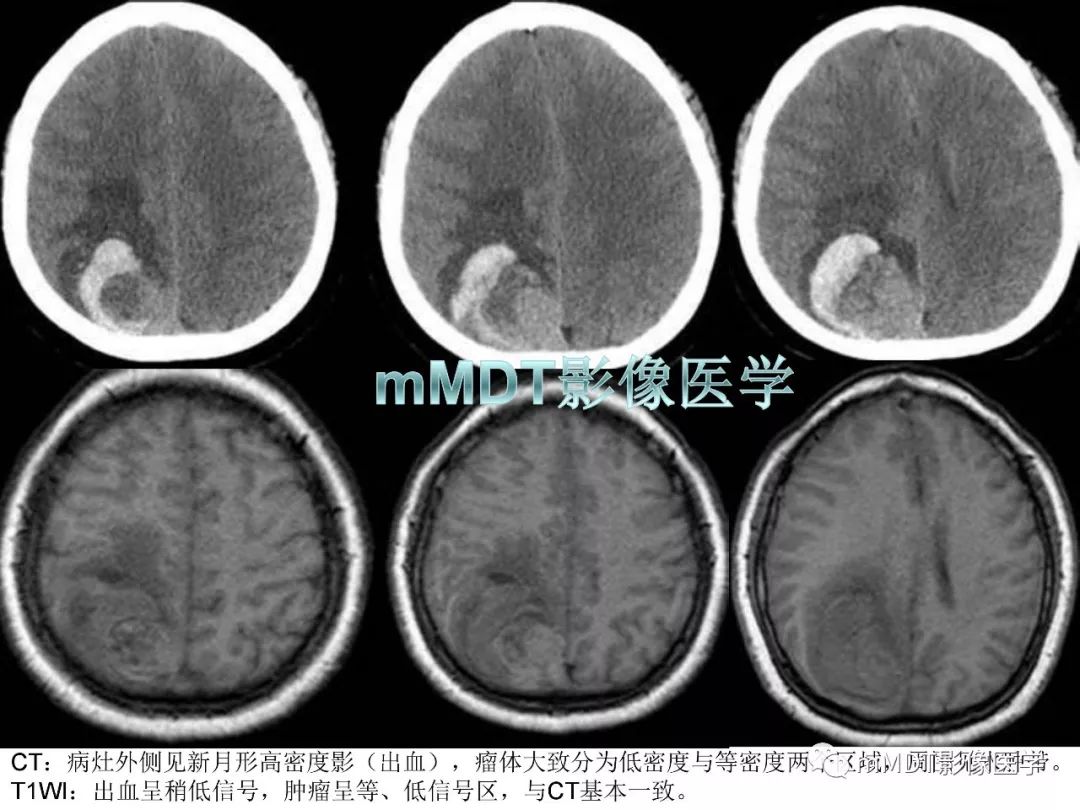 【PPT】脑膜肿瘤影像诊断——间质、非脑膜上皮性源性脑膜肿瘤