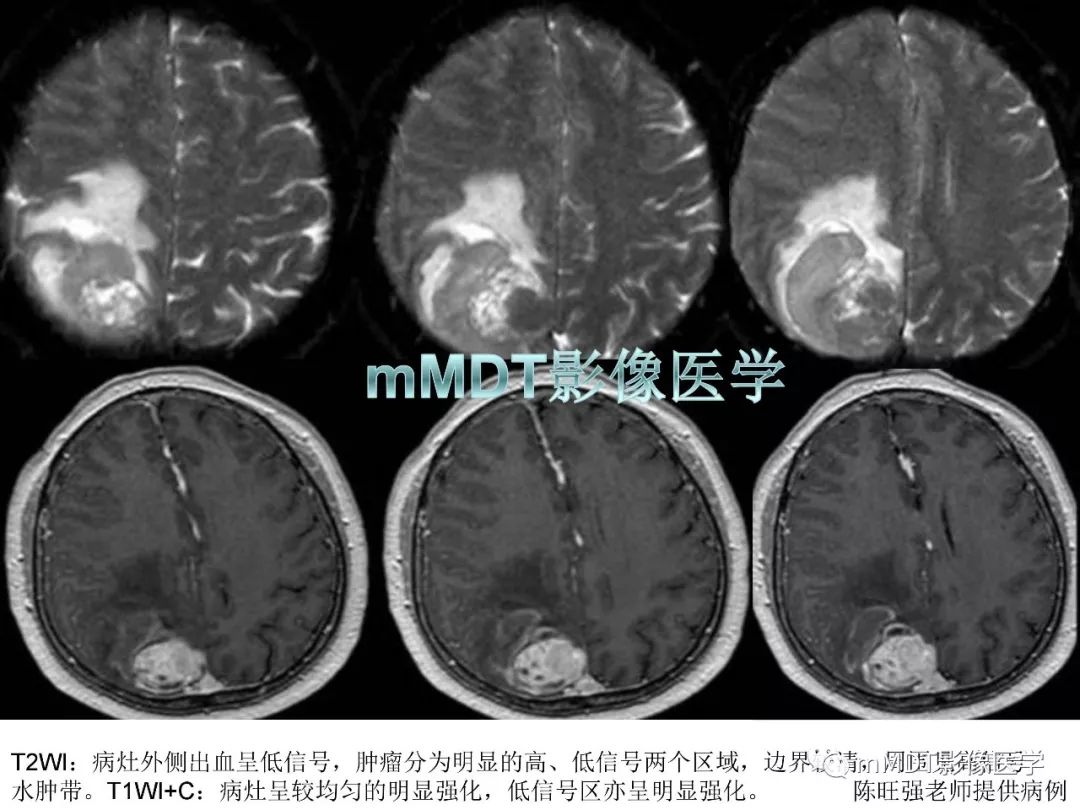 【PPT】脑膜肿瘤影像诊断——间质、非脑膜上皮性源性脑膜肿瘤