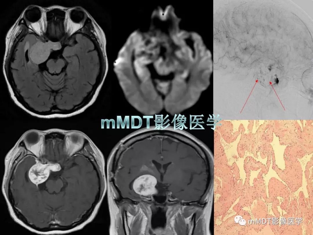 【PPT】脑膜肿瘤影像诊断——间质、非脑膜上皮性源性脑膜肿瘤