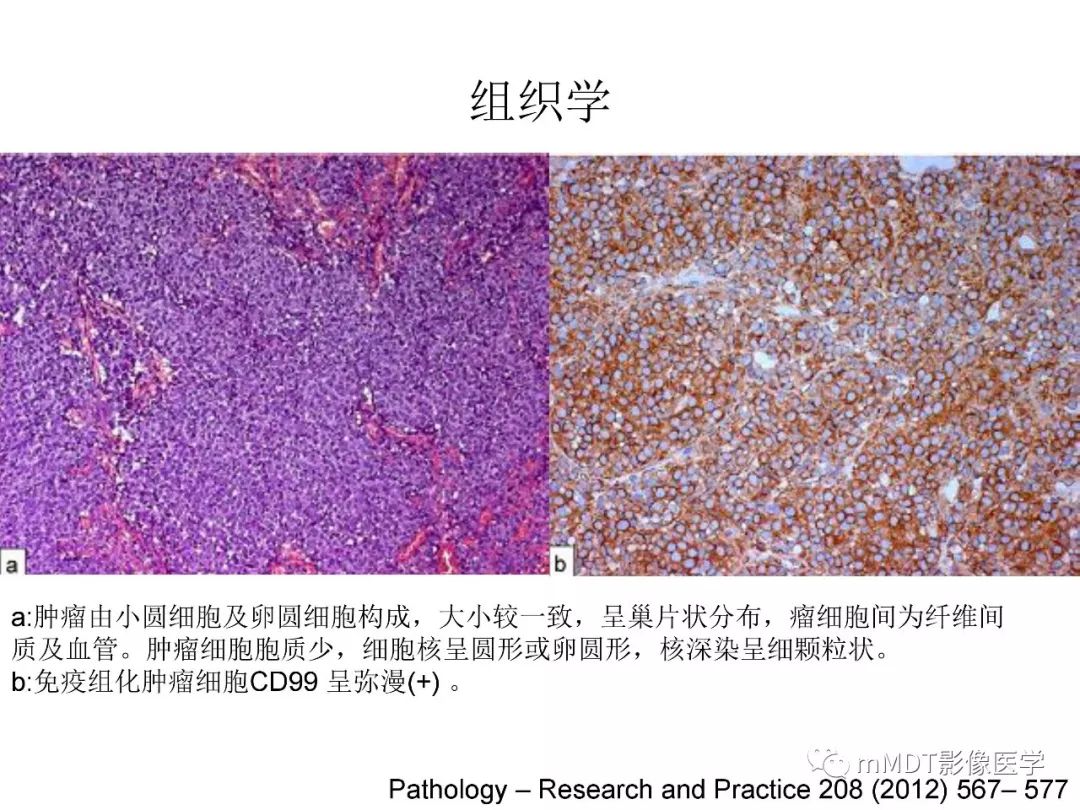 【PPT】脑膜肿瘤影像诊断——间质、非脑膜上皮性源性脑膜肿瘤