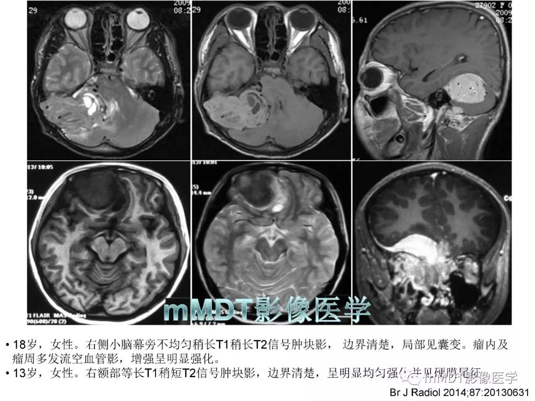 【PPT】脑膜肿瘤影像诊断——间质、非脑膜上皮性源性脑膜肿瘤