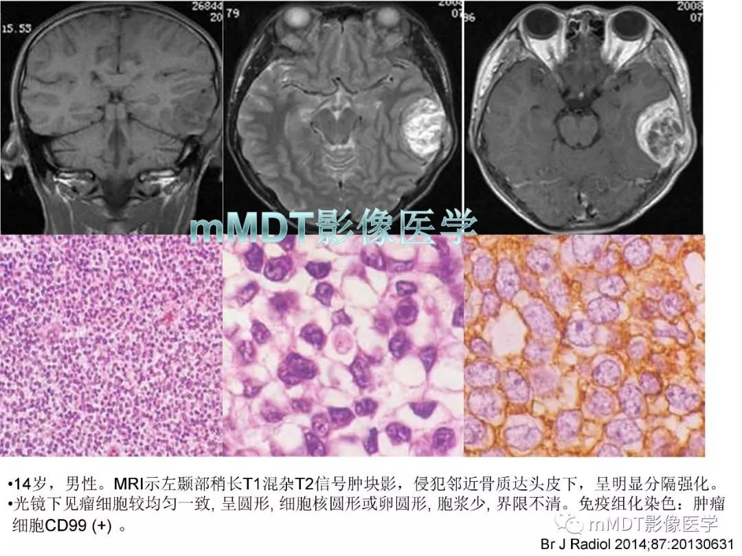 【PPT】脑膜肿瘤影像诊断——间质、非脑膜上皮性源性脑膜肿瘤