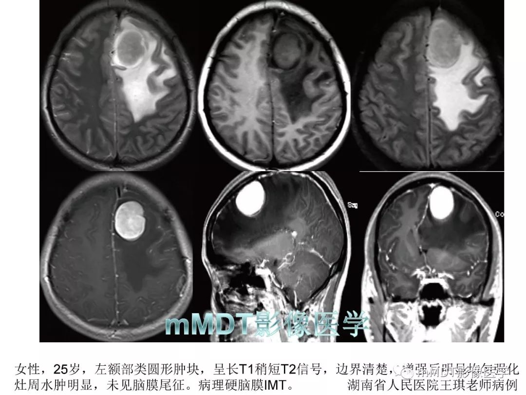 【PPT】脑膜肿瘤影像诊断——间质、非脑膜上皮性源性脑膜肿瘤