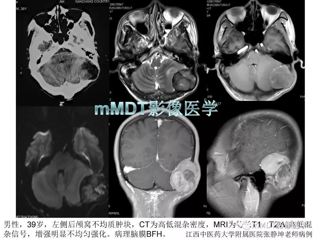 【PPT】脑膜肿瘤影像诊断——间质、非脑膜上皮性源性脑膜肿瘤