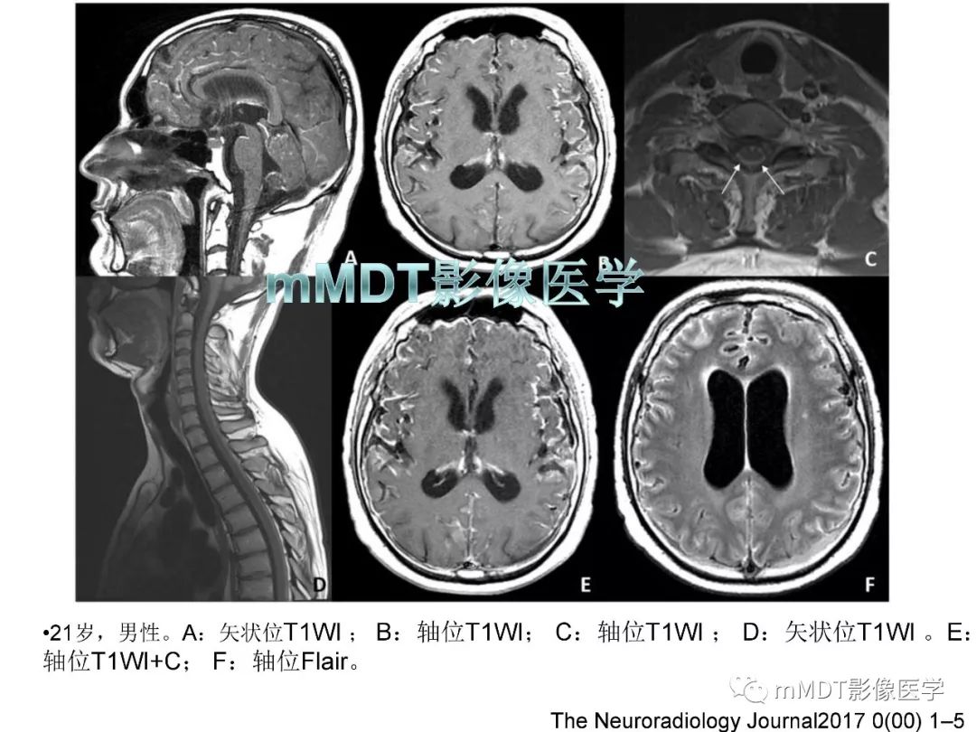 【PPT】脑膜肿瘤影像诊断——间质、非脑膜上皮性源性脑膜肿瘤
