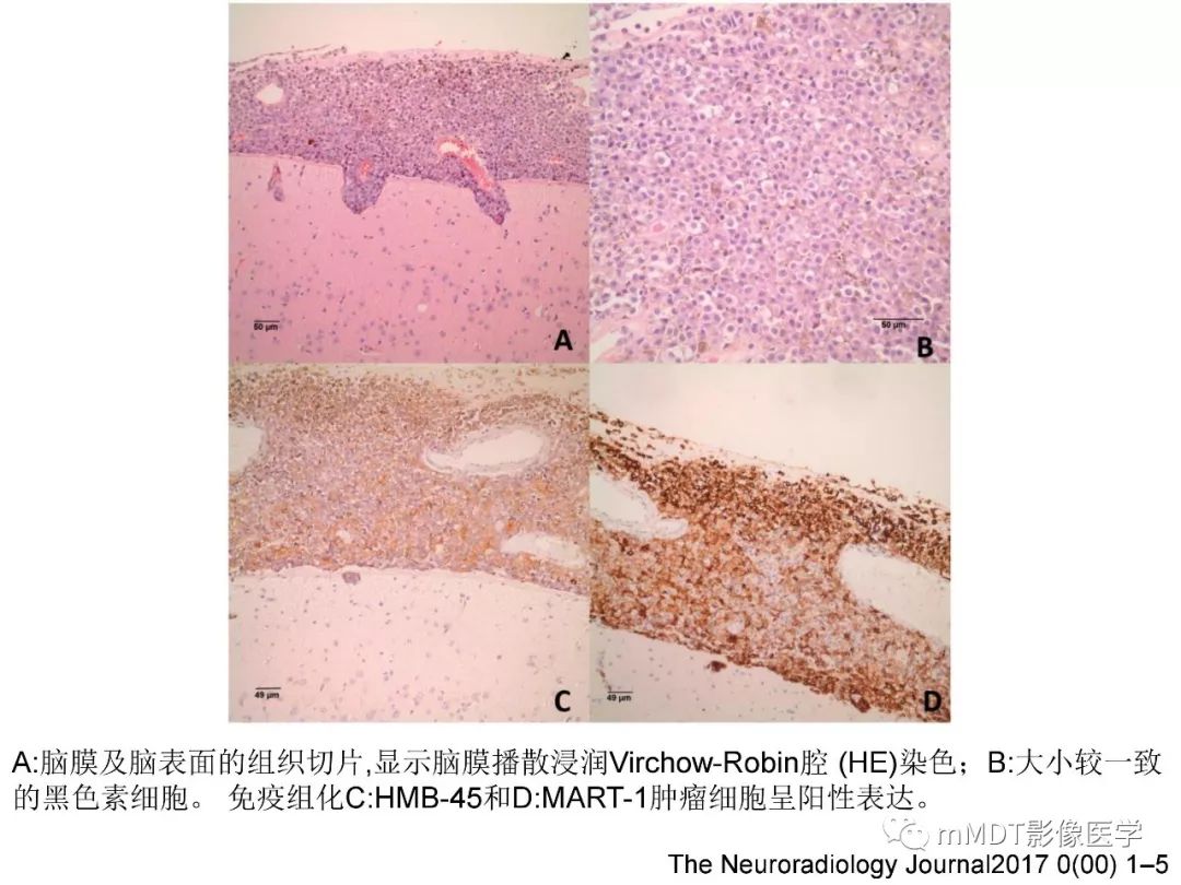 【PPT】脑膜肿瘤影像诊断——间质、非脑膜上皮性源性脑膜肿瘤