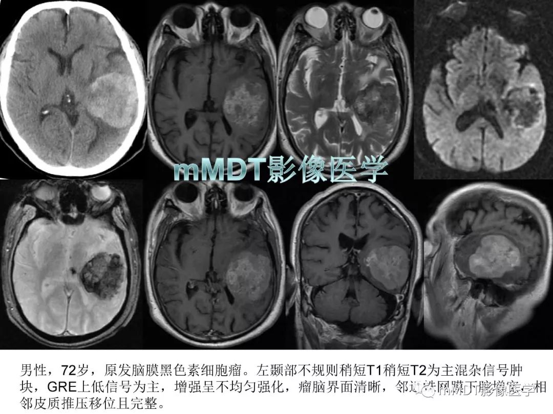 【PPT】脑膜肿瘤影像诊断——间质、非脑膜上皮性源性脑膜肿瘤