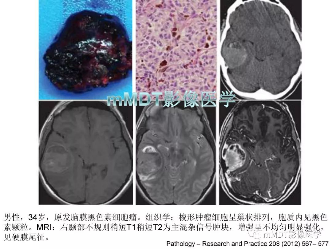 【PPT】脑膜肿瘤影像诊断——间质、非脑膜上皮性源性脑膜肿瘤