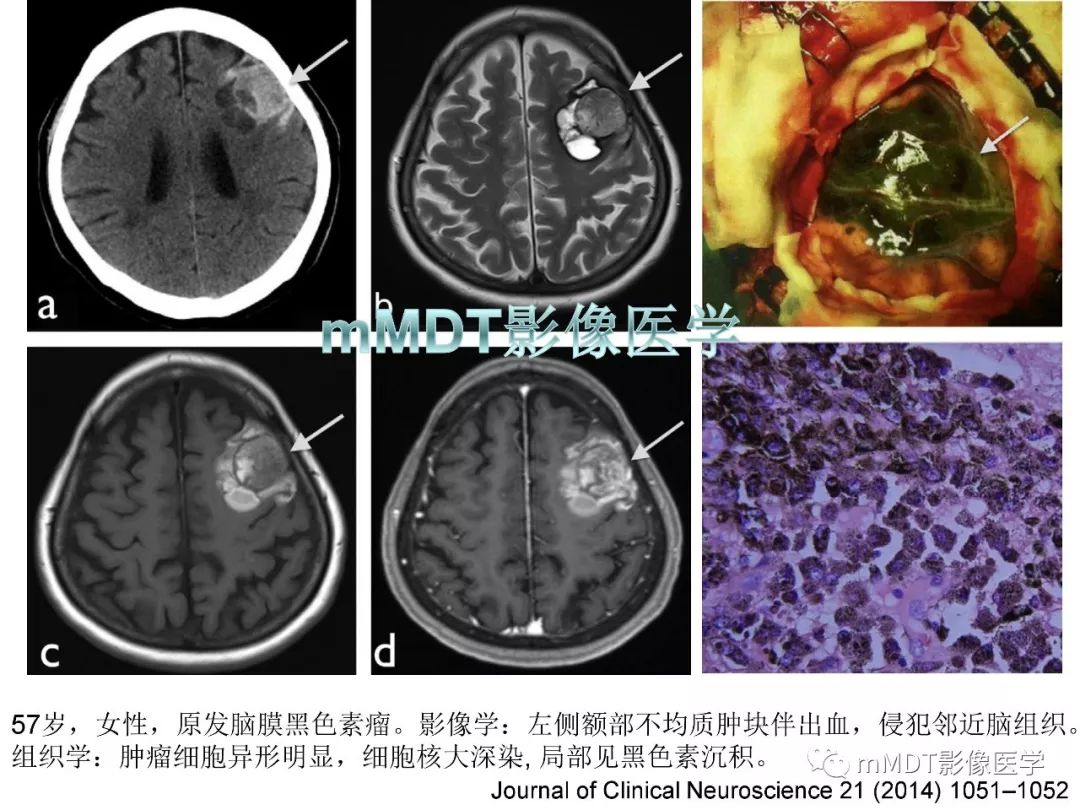 【PPT】脑膜肿瘤影像诊断——间质、非脑膜上皮性源性脑膜肿瘤