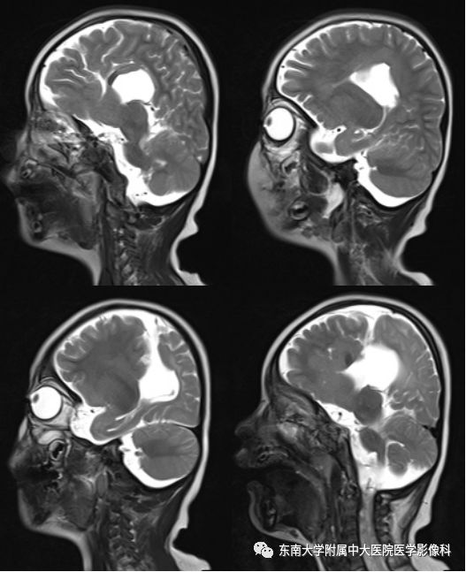 【病例】分离型脑裂畸形、脑灰质异位、透明隔缺如、胼胝体发育不良1例MR