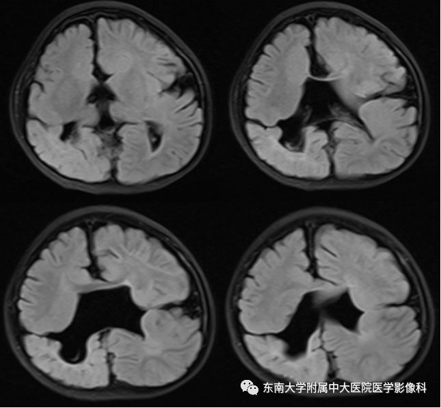 【病例】分离型脑裂畸形、脑灰质异位、透明隔缺如、胼胝体发育不良1例MR