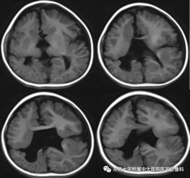 【病例】分离型脑裂畸形、脑灰质异位、透明隔缺如、胼胝体发育不良1例MR