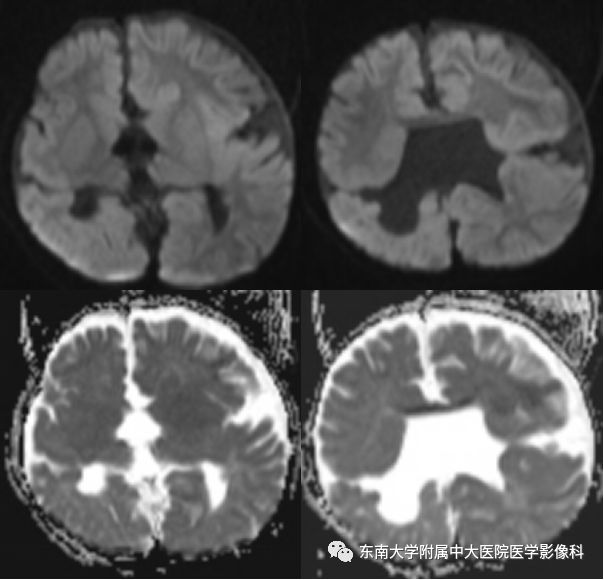 【病例】分离型脑裂畸形、脑灰质异位、透明隔缺如、胼胝体发育不良1例MR