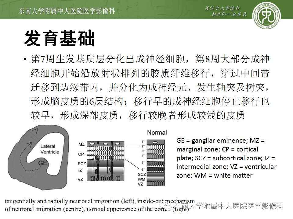 【病例】分离型脑裂畸形、脑灰质异位、透明隔缺如、胼胝体发育不良1例MR