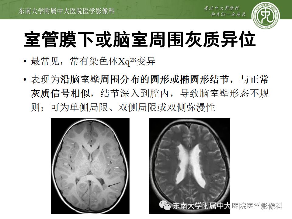 【病例】分离型脑裂畸形、脑灰质异位、透明隔缺如、胼胝体发育不良1例MR