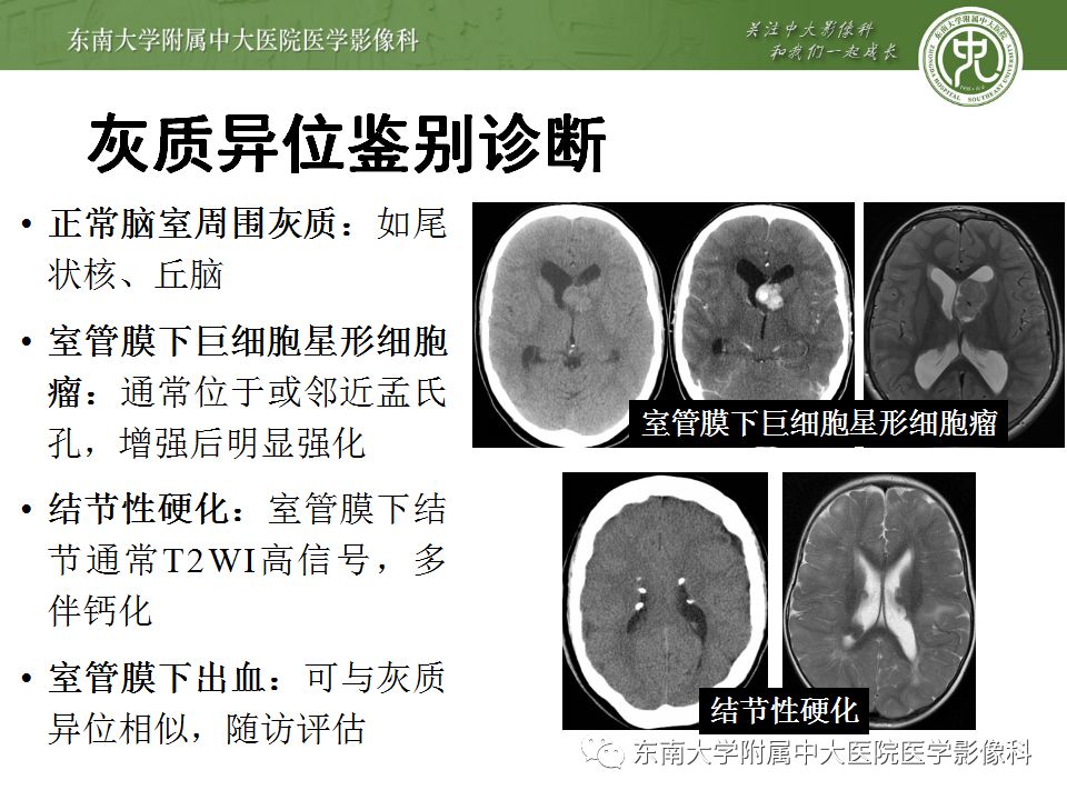 【病例】分离型脑裂畸形、脑灰质异位、透明隔缺如、胼胝体发育不良1例MR